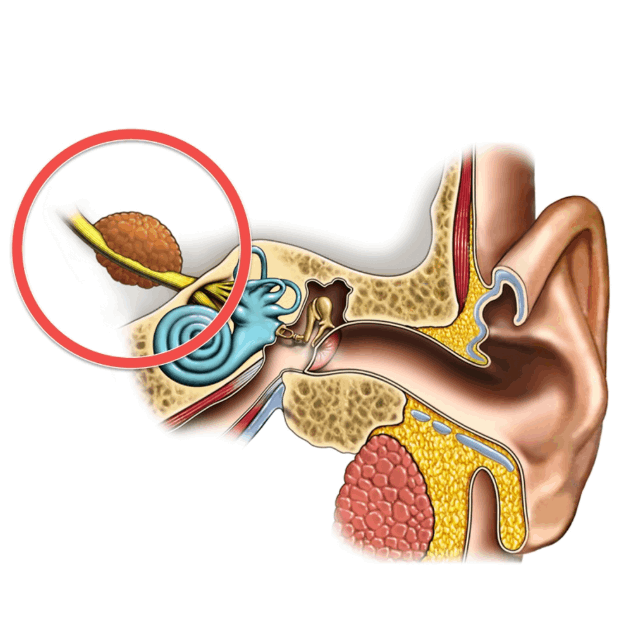 听神经瘤的平均大小和术后听力恢复情况如何?