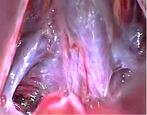 松果体区肿瘤手术会瘫痪吗