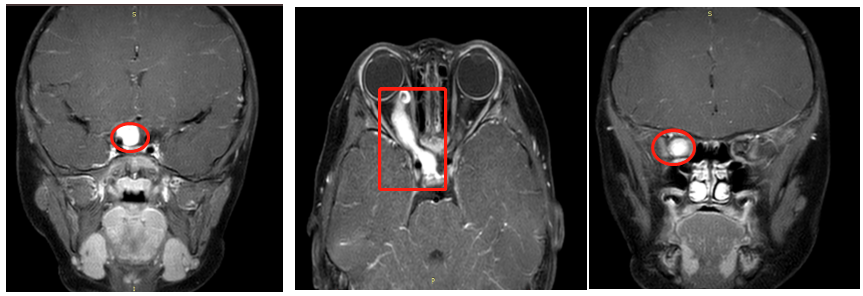 儿童视路胶质瘤手术后视力能恢复吗？视路胶质瘤能治好吗