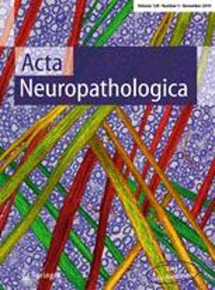 脑干胶质瘤液体活检-Acta Neuropathologica