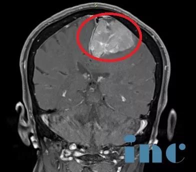 颅内巨大脑膜瘤案例图片3