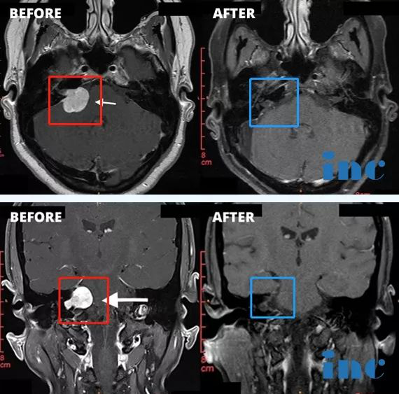 听神经瘤案例,听神经瘤手术