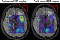 美国哈佛医学院新颖的成像方法揭示了针对脑胶质瘤的靶向治疗背后的机制