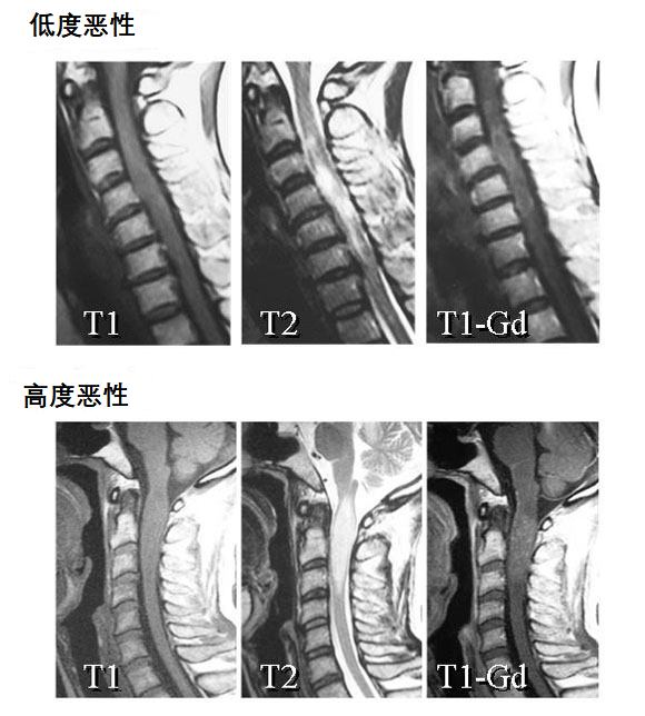 脊髓肿瘤