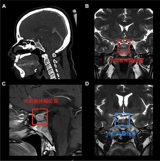垂体瘤案例