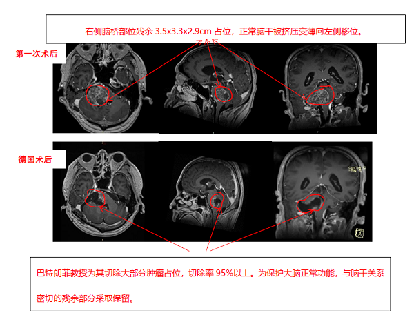 脑胶质瘤案例图片