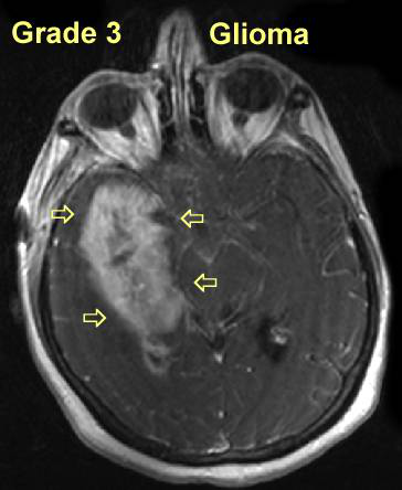 恶性脑瘤3-4级手术治疗