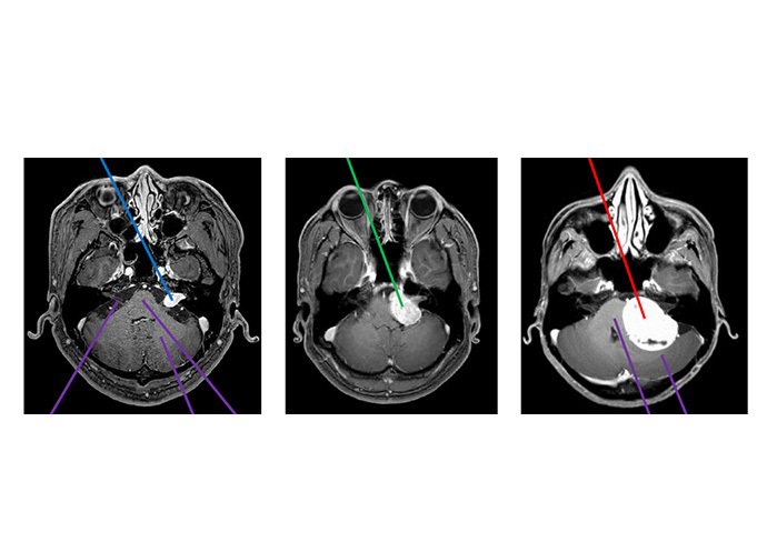 听神经瘤MRI