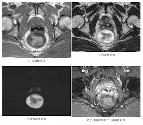 脊索瘤患者MRI影像