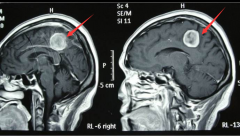 大脑镰旁脑膜瘤术后存活率高吗？