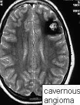 什么是脑海绵状血管瘤？