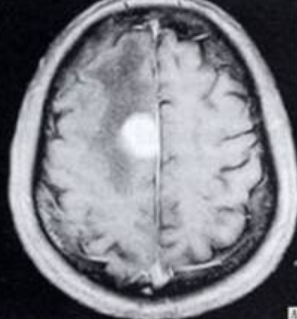 大脑镰旁脑膜瘤4厘米