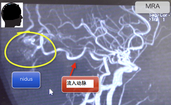 脑动静脉畸形