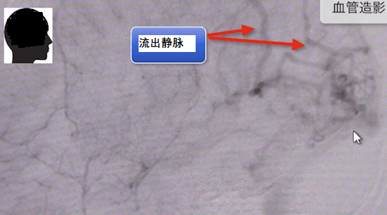 脑动静脉畸形