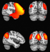 SickKids临床经验分享：脑磁图引导的顽固性癫痫患儿的癫痫手术