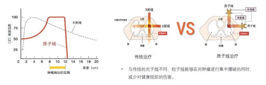 脑胶质瘤质子治疗