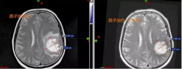 质子治疗胶质瘤案例对比