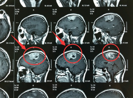左顶镰旁脑膜瘤手术