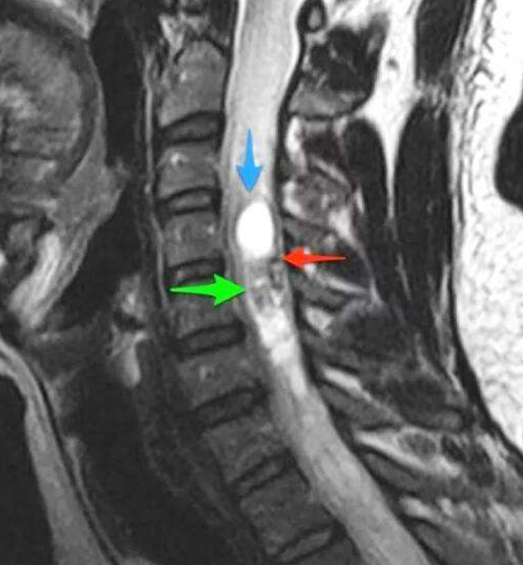 <a href='/bingzhong/smxbl/' target='_blank'><u>髓母细胞瘤</u></a>