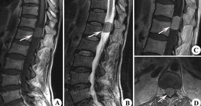 脊髓肿瘤影像学图