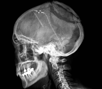 儿童脑脊髓肿瘤的早期症状有哪些?