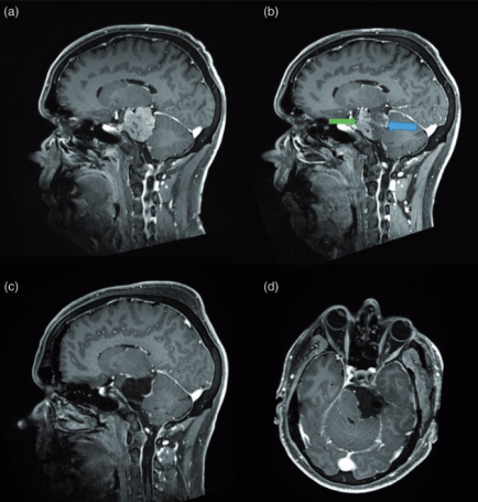 不可能的手术：巨大岩斜脑膜瘤在Froelich教授手术下完全切除