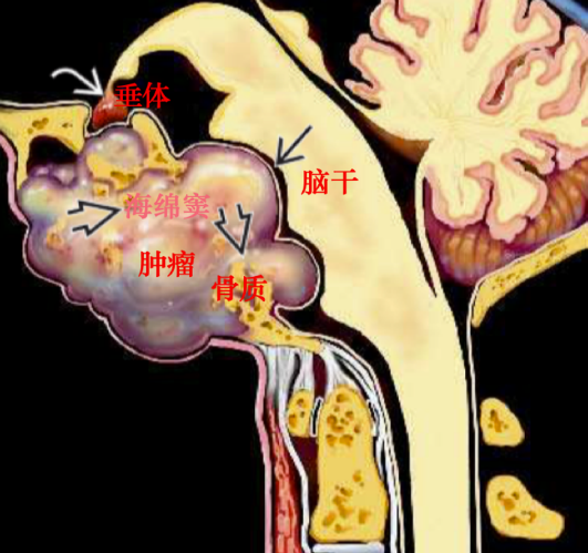 颅底脊索瘤