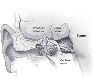 【听神经瘤】听神经鞘瘤切除是不是大手术？