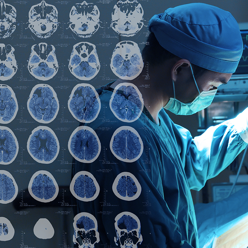 德国巴特朗菲教授中脑海绵状血管瘤的72例显微手术案例报告