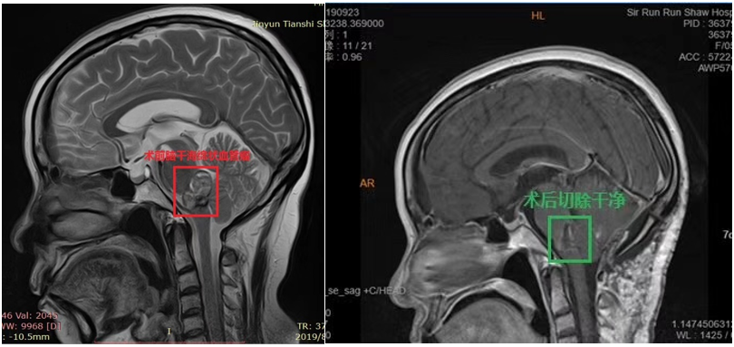 脑海绵状血管瘤案例