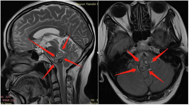 脑海绵状血管瘤案例