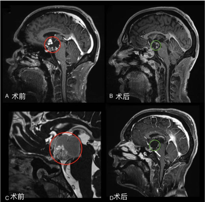 颅咽管瘤