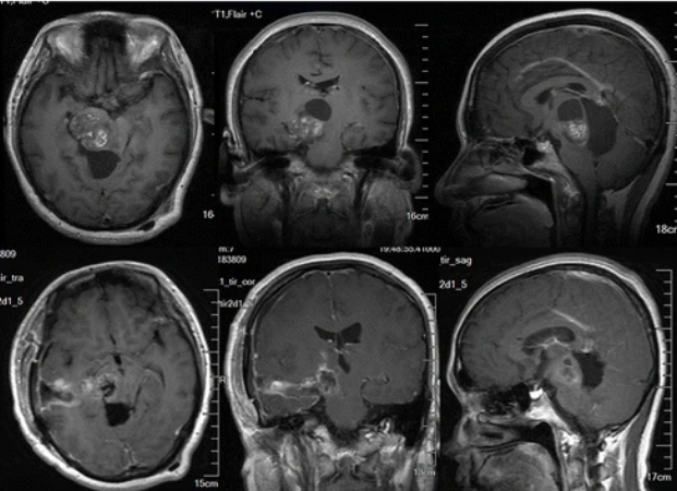 较难手术之一的丘脑胶质瘤，手术后生存期有多长？
