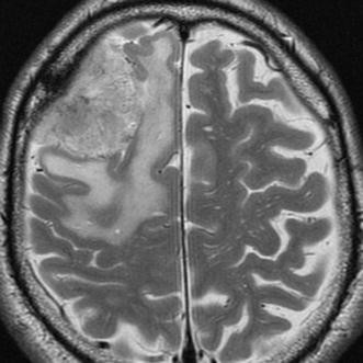 大脑凸面脑膜瘤复发率多少?