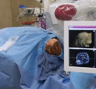 大师Rutka教授综述|SEEG及机器人在癫痫手术中的临床应用和难题