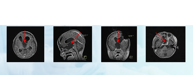 德国<a href='/jiaoshou/24.html' target='_blank'><u>巴特朗菲</u></a>教授——视神经胶质瘤案例