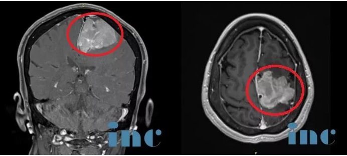术前MR——巨大脑膜瘤手术