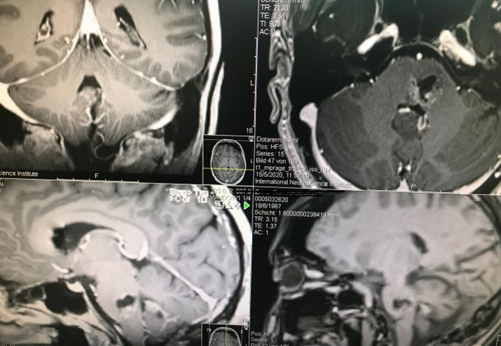 手术报告|脑干海绵状血管瘤误诊为胶质瘤，终于手术全切、恢复佳