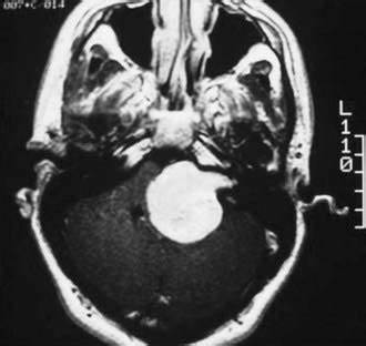 听神经瘤早期详细表现，听神经瘤的第一个症状是什么？