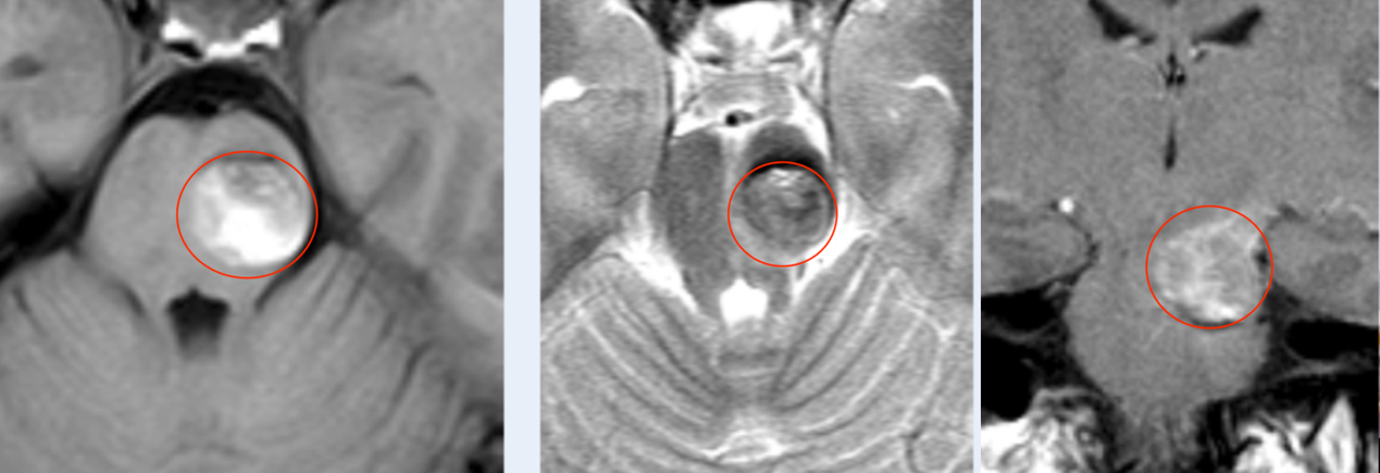 脑干肿瘤案例