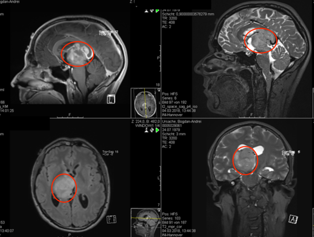「胶质瘤案例」脑干巨大丘脑胶质瘤次全切手术