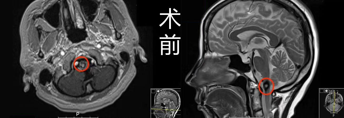 <a href='/bingzhong/xueguanliu/' target='_blank'><u>脑海绵状血管瘤</u></a>——脑干血管病变
