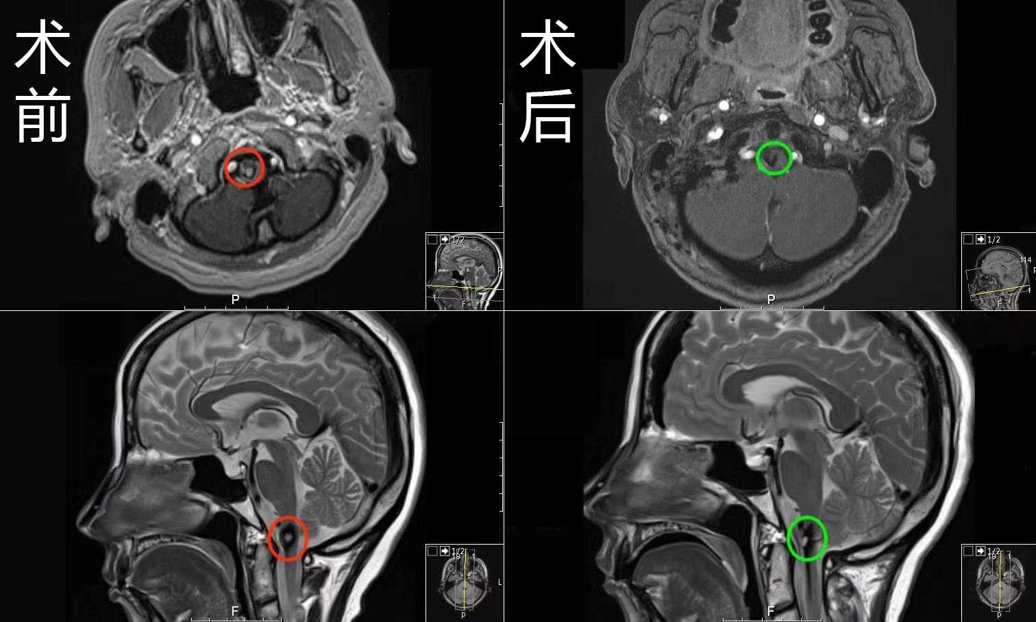 脑干血管病变案例对比