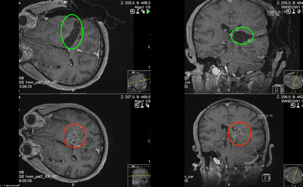 丘脑胶质瘤图片