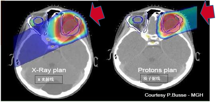 质子治疗脑瘤