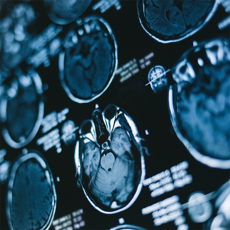 脑动脉瘤的前兆是什么？如何诊断和修复？