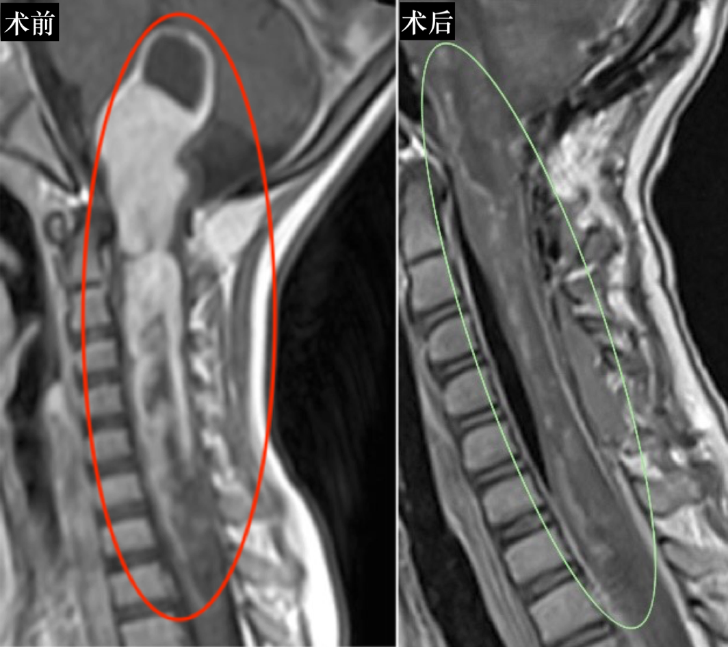 脑干胶质瘤——术前对比
