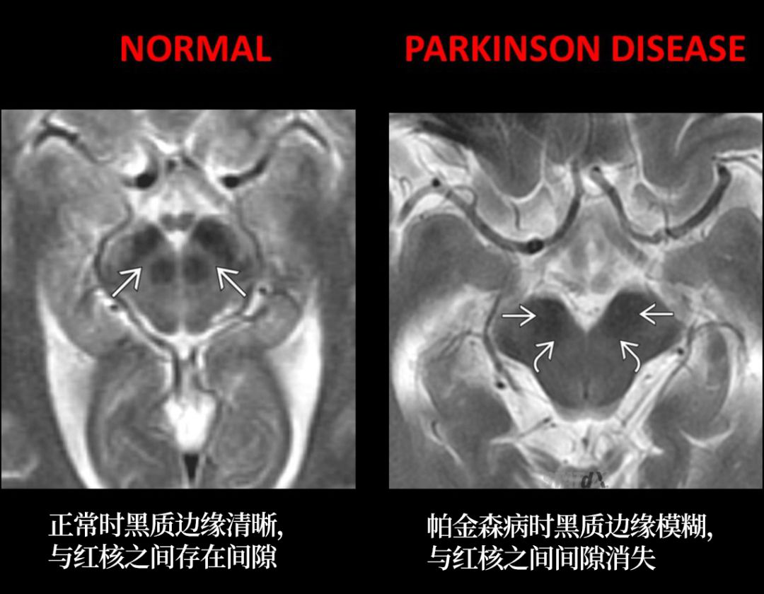 帕金森病和帕金森综合征