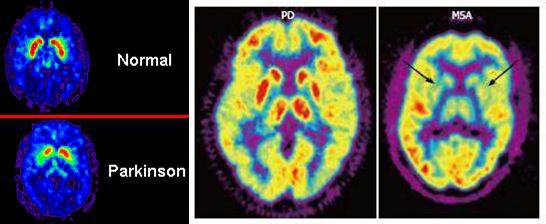 FDG-PET显示PD基底节代谢活动得到保留，而MSA基底节代谢明显减低