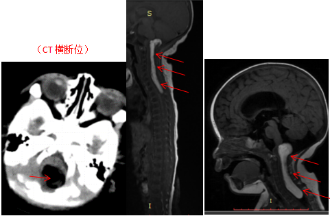 儿童肿瘤